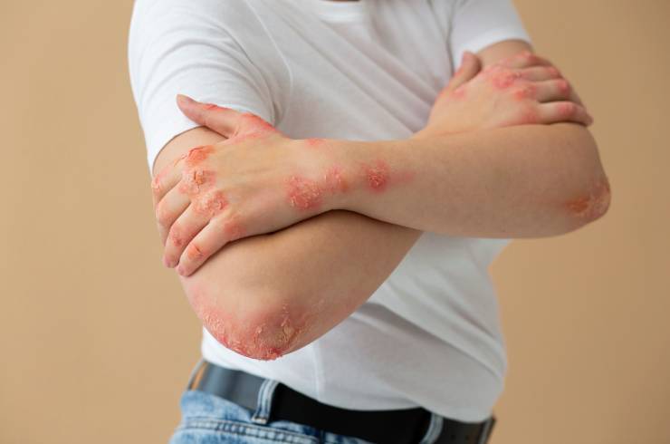 Dermatology
